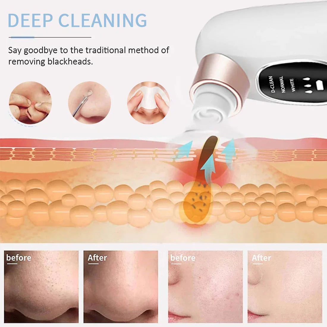 Electric Blackhead Remover Vacuum – Deep Pore Cleaner with LED & 4 Suction Heads for Face & Nose