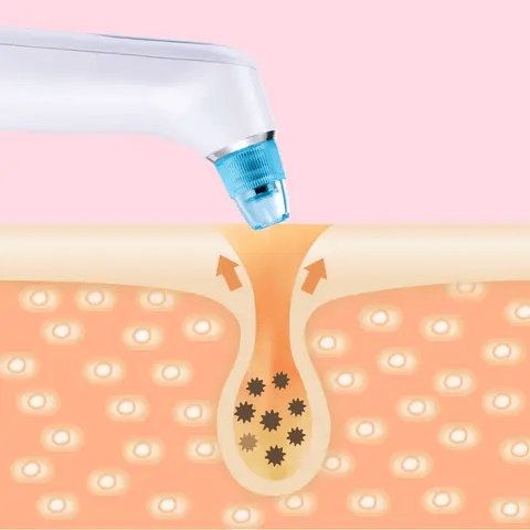 Electric Blackhead Remover Vacuum – Deep Pore Cleaner with LED & 4 Suction Heads for Face & Nose