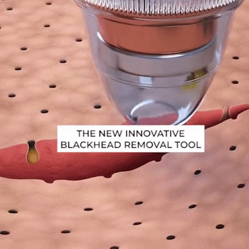 Electric Blackhead Remover Vacuum – Deep Pore Cleaner with LED & 4 Suction Heads for Face & Nose