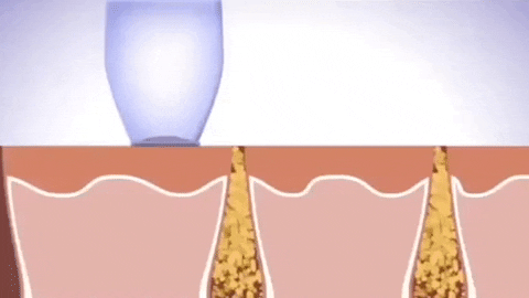 Electric Blackhead Remover Vacuum – Deep Pore Cleaner with LED & 4 Suction Heads for Face & Nose