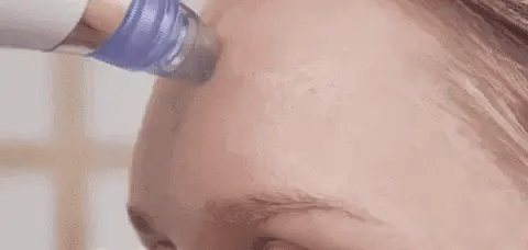 Electric Blackhead Remover – Suction Pore Cleaner & Beauty Tool