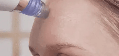 Electric Blackhead Remover – Suction Pore Cleaner & Beauty Tool